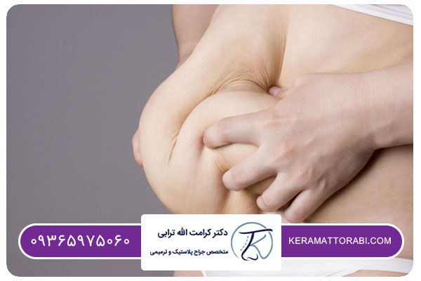 منظور از ابدومینوپلاستی چیست؟ | دکتر کرامت الله ترابی