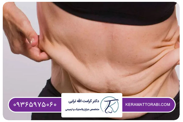ورم شكم پس از انجام ابدومينوپلاستي