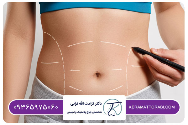 کاربرد جراحی ابدومینوپلاستی چیست؟